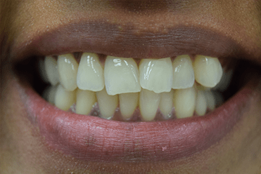 Smile Design Dental - Before