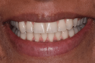 After - Smile Design Dental