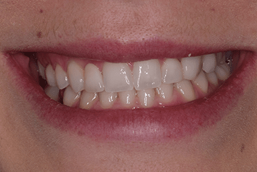 After - Smile Design Dental