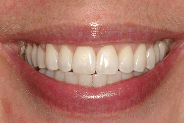 After - Smile Design Dental