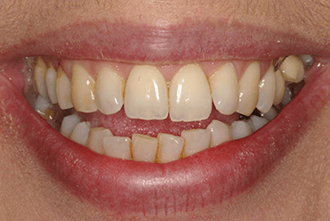 Before - Smile Design Dental