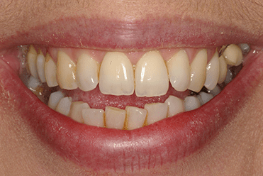 Before - Smile Design Dental 