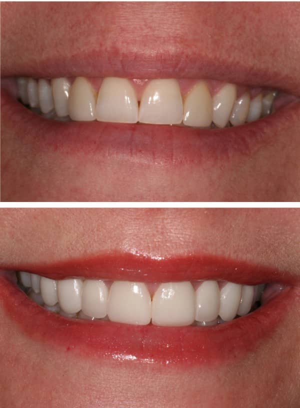 LUMINEERS VS VENEERS Smile Design Dental Practice Dentist in