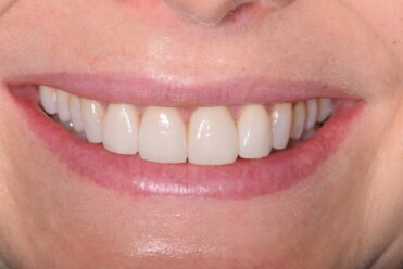 Smile Design Dental - After