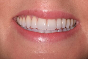 After - Smile Design Dental