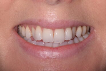 Before - Smile Design Dental 