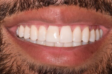 Smile Design Dental - After