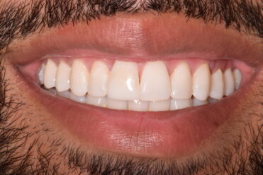 After - Smile Design Dental