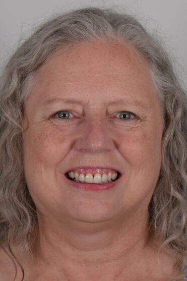Smile Design Dental - After
