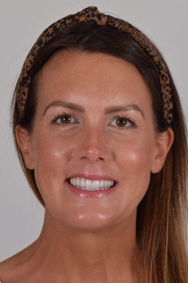 Smile Design Dental - After