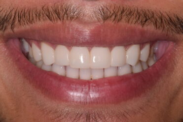 After - Smile Design Dental