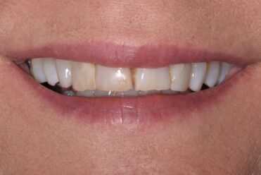 Smile Design Dental - Before