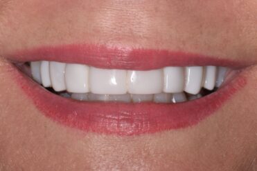 After - Smile Design Dental
