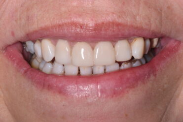 After - Smile Design Dental