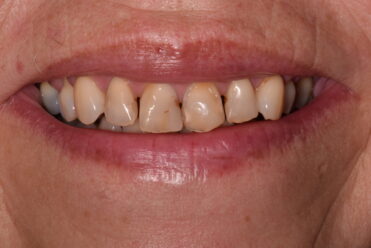 Smile Design Dental - Before