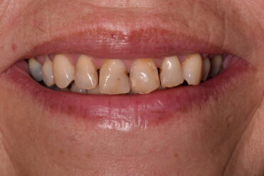 Before - Smile Design Dental 